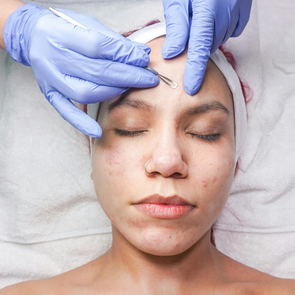 Acne Facial